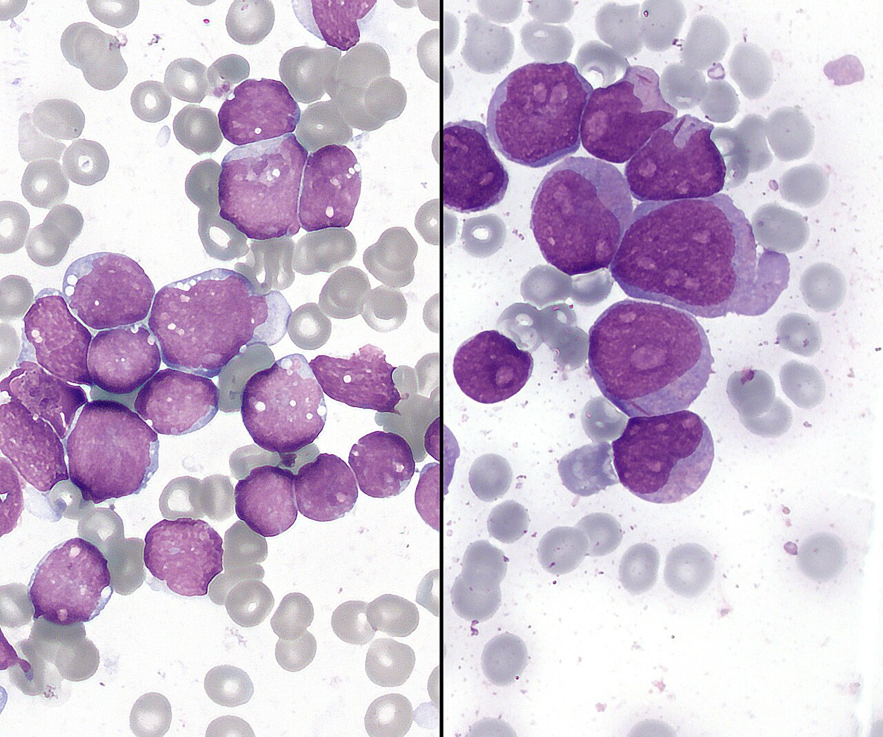 Chemotherapy (6 cycles)