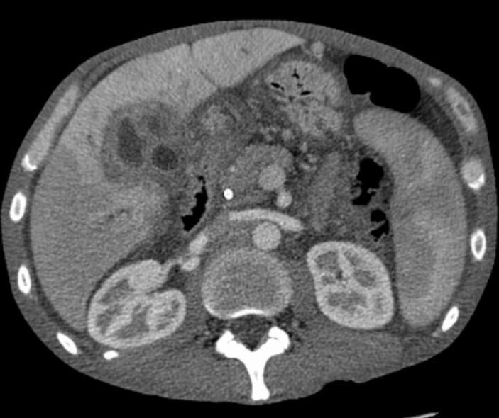 Liver Cancer Treatment
