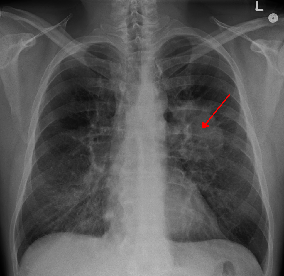 Lung Cancer Treatment Package