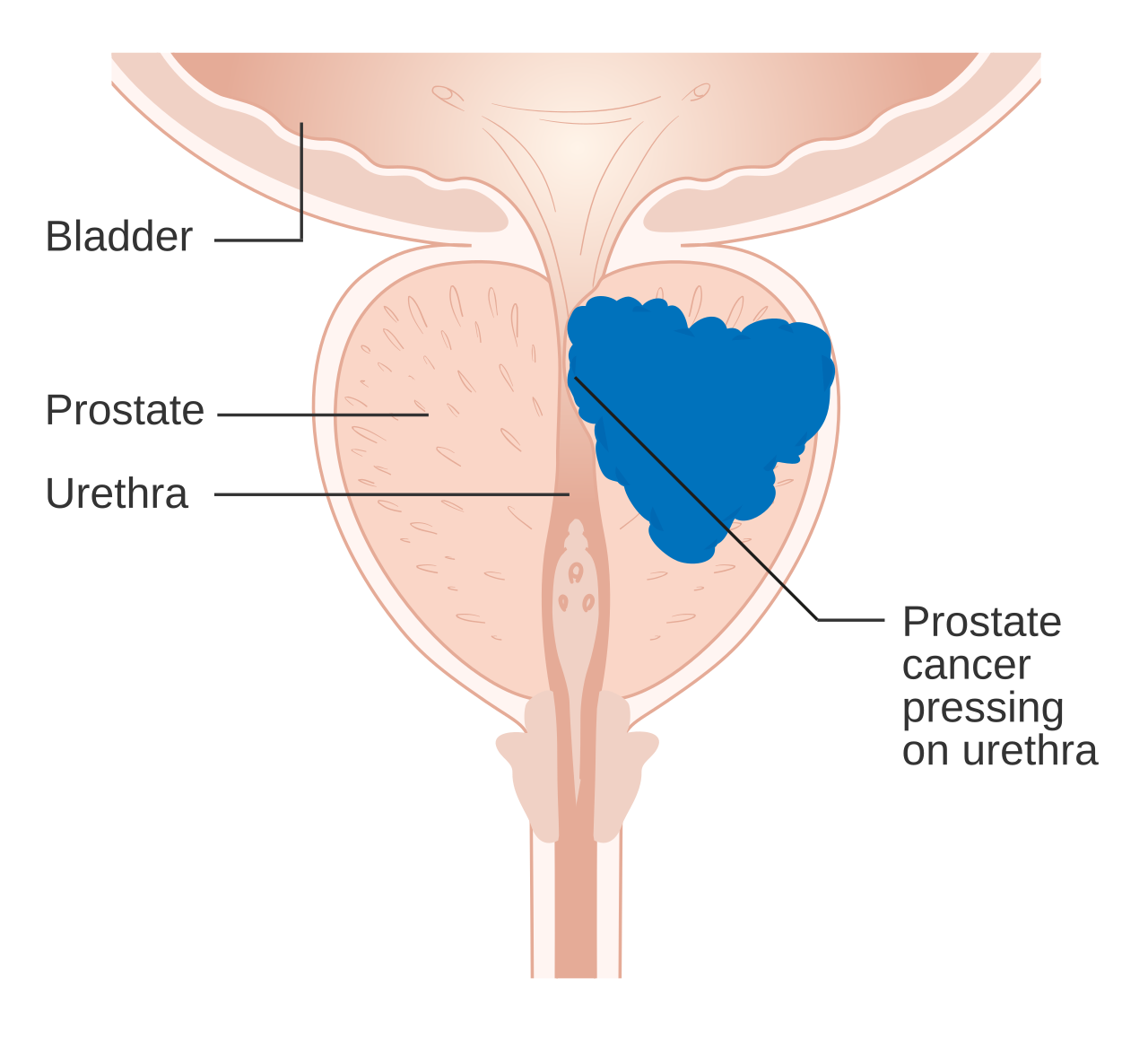 Prostate Cancer